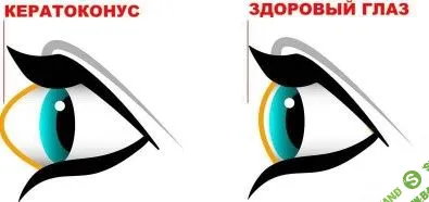 Убираем кератоконус. Возвращаем нормальную форму глаз [Людмила Лазарева]
